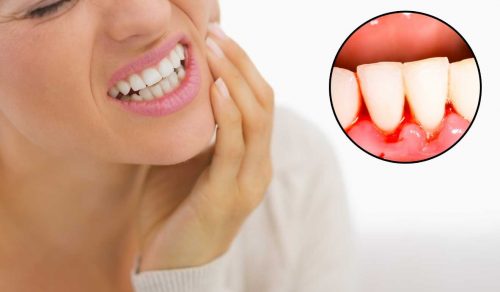 Gum Bleeding Remedies : मसूढ़ों से खून बहने लगा है और दर्द भी हो रहा है तो अपनाएं ये उपाय