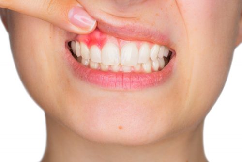 How To Cure Mouth Ulcers : क्या आप अक्सर मुंह के छालों से परेशान रहते हैं? रामबाण माने जाते हैं ये घरेलू नुस्खे