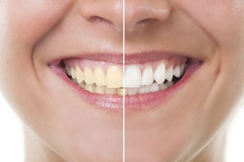 Get Rid Of Yellowing Of Teeth : अगर मुस्कुराते हुए आपके दांत पीले दिखते हैं, तो अपनाएं ये टिप्स