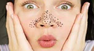 Blackheads की समस्या से छुटकारा पाने के लिए घरेलू उपाय