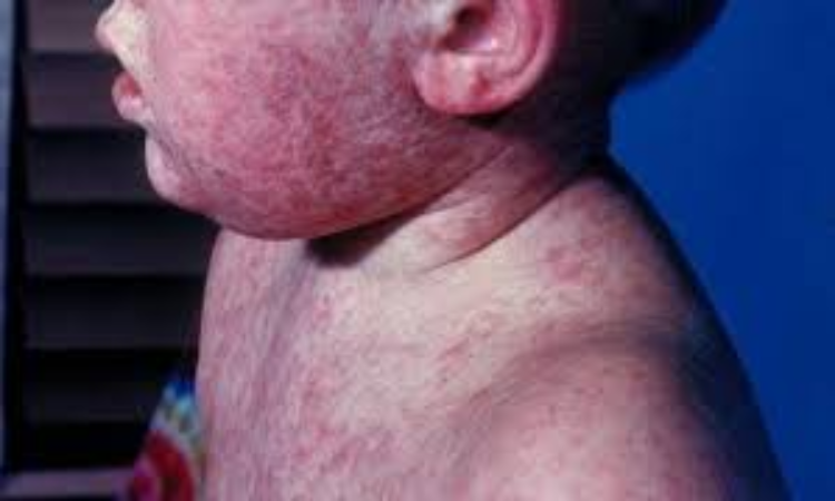 Measles: खसरे को लेकर WHO की वार्निंग, जानें क्या हैं इसके लक्षण