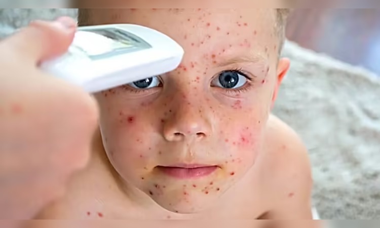 Measles (Khasra) symptoms: तेजी से बच्चों में फैल रही है ये बीमारी, जानें इसके लक्षण और बचाव का उपाए