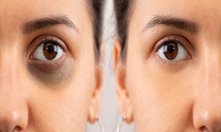 Dark Circles: आंखों के नीचे हैं काले घेरे, अपनाएं ये नुस्खे