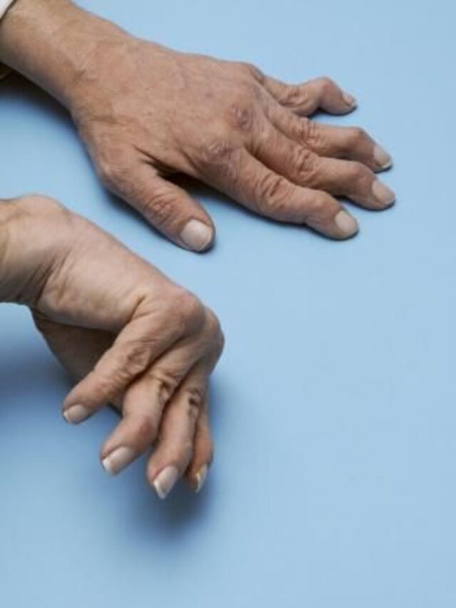 हाथ पैर की मुड़ी हुई उंगलियां इस बीमारी का देती हैं संकेत